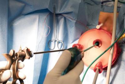 El Consorci Sanitari Alt Penedès-Garraf impulsa una cirurgia ginecològica innovadora. CSAPG